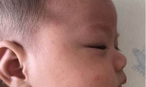 孩子身上起紅疹是怎么回事？