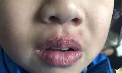 孩子嘴唇干裂怎么辦？